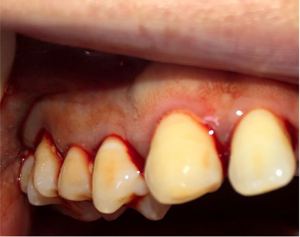 牙周基础治疗--龈下刮治术