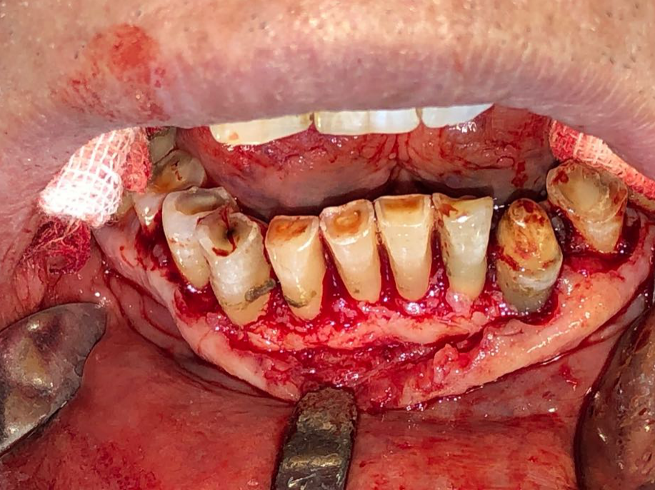 牙周基础治疗--龈下刮治术