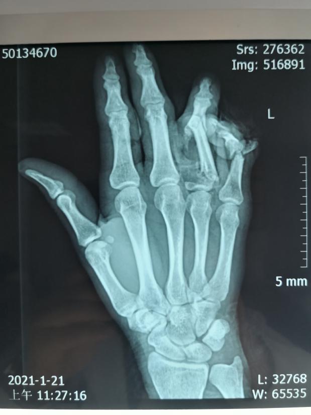 4个小时手术 抢 回了患者的手指 三秦网