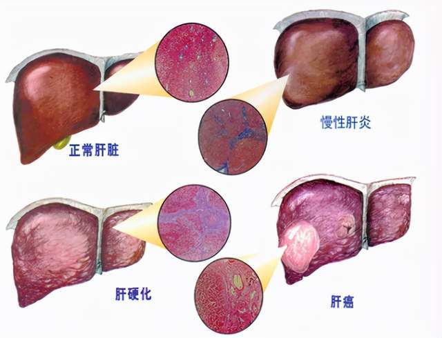 西安大兴医院肝硬化MDT联合门诊开诊