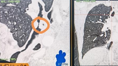 3毫米呼吸空间！欧阳海峰团队极速开通狭窄气道保障患者安全