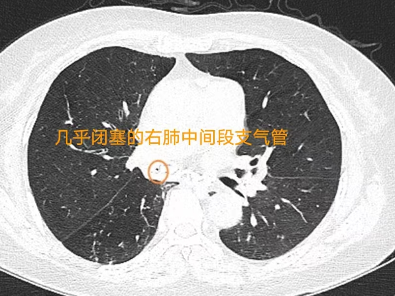 冷冻探路+球囊扩张“开通”闭塞气道，她又开始自由呼吸啦！