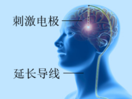 脑起搏器轻松解决男子“挤眉弄眼”怪病