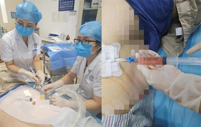 男子肾囊肿似鹅蛋  肾内超声携手巧去除