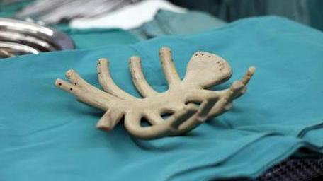 多学科协作11小时手术 3D打印胸骨助力 抗癌30年的她重获新生