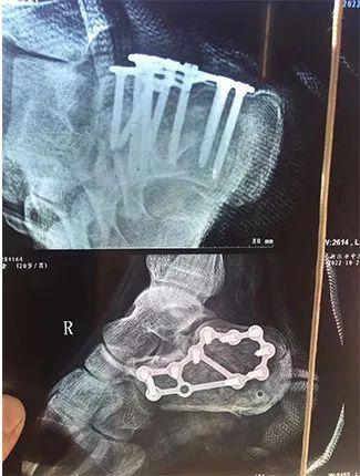 被植入多根鋼釘足跟粉碎性骨折閆單童卻受了重傷孩子得到及時救治毫不