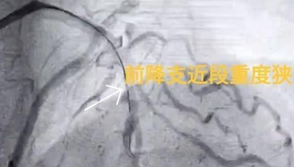 七年前心绞痛大意七年后血管堵实 红会心血管内科一招解决