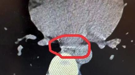 男子吃鱼不慎鱼刺穿破食管壁    医生胸腔镜下巧妙取出无大碍