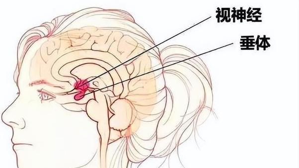 视力下降以为是眼睛问题 元凶竟是颅内肿瘤在作祟