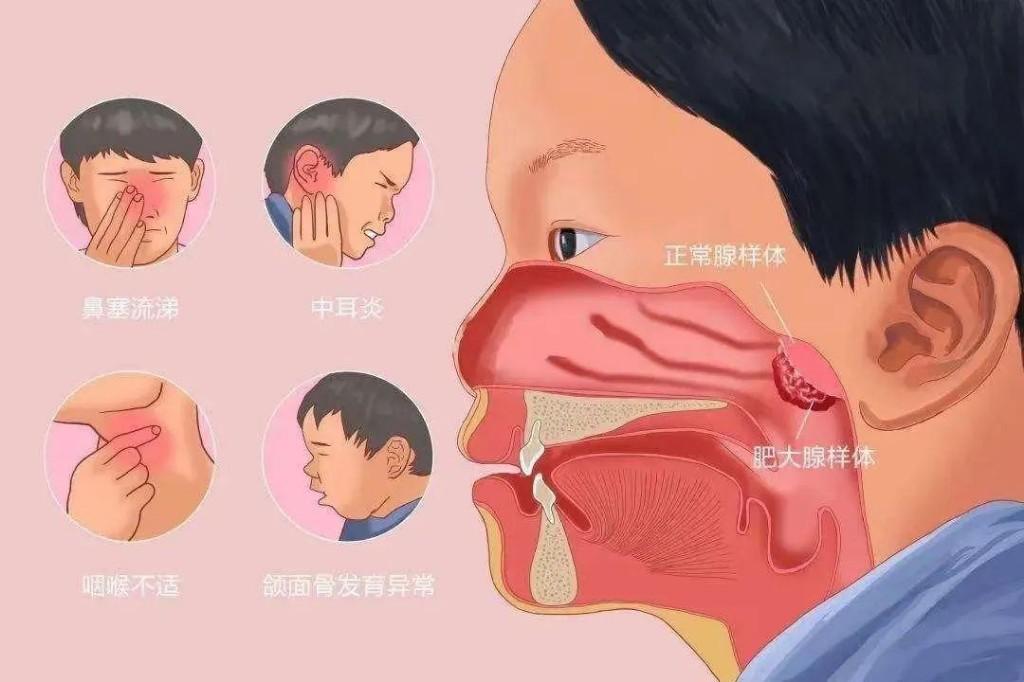 孩子睡觉打鼾不是睡得香，小儿鼾症你知多少？
