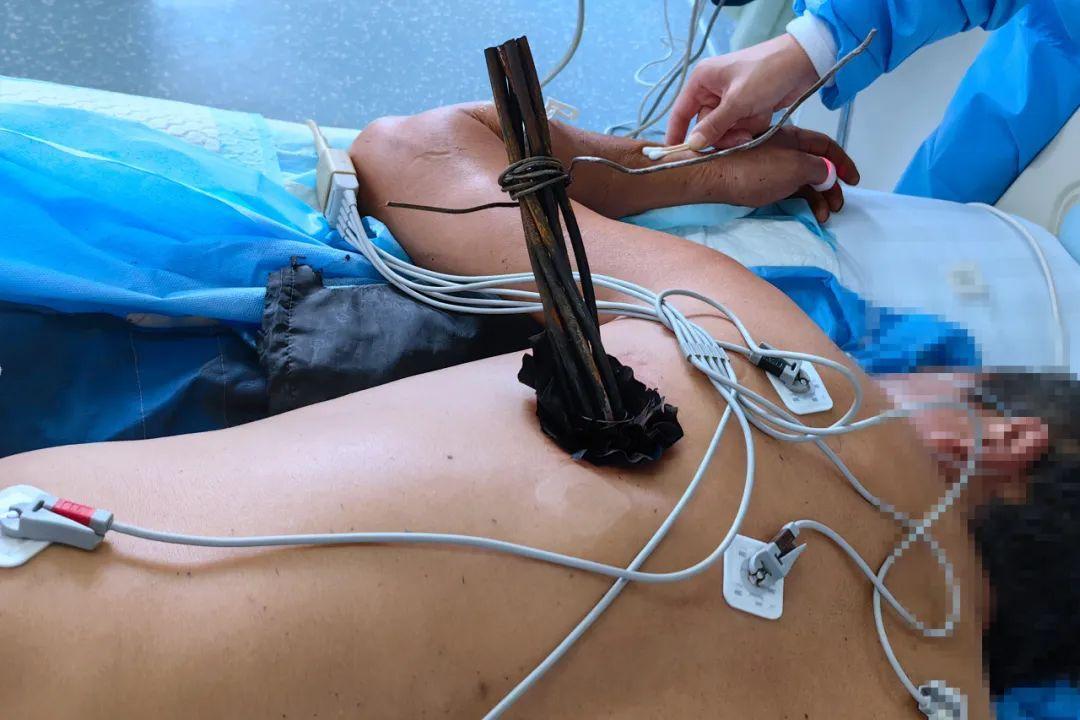 七根钢筋直插工友胸腔生命垂危   多科室协作紧急施救逃出鬼门关