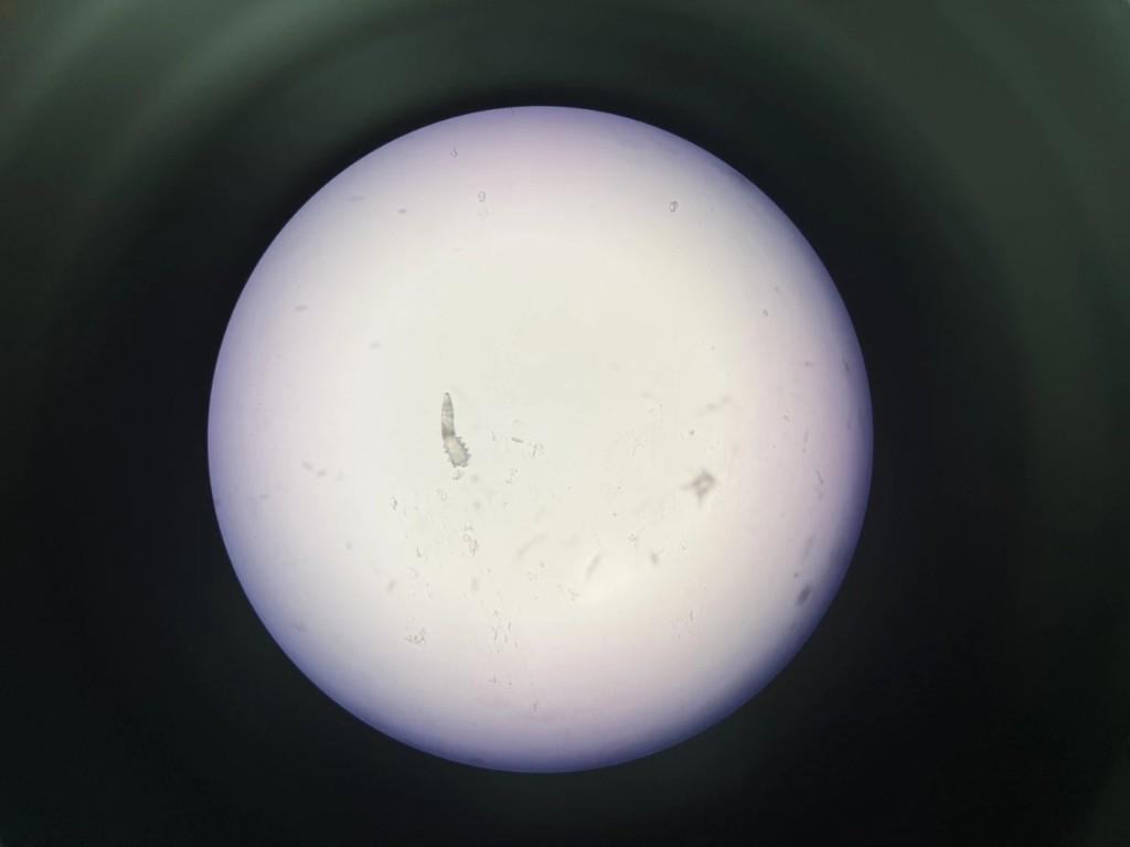 眼睛发痒当结膜炎误治半年 揪出真凶竟是睫毛根部螨虫