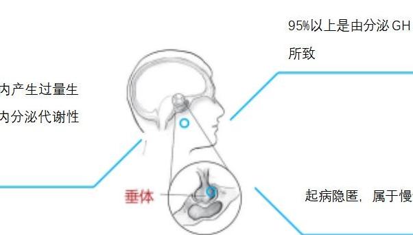 别让“肢端肥大”偷走健康