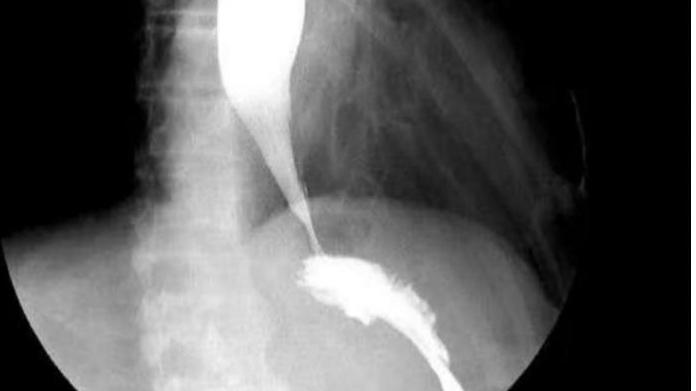 “3年了，我几乎忘记了正常吃饭是什么感觉……”