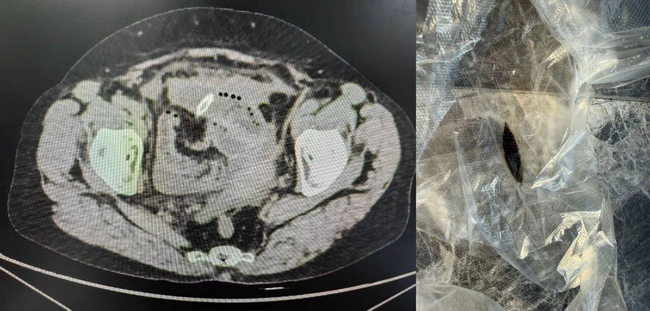 誤吞棗核刺穿腸釀大禍 醫生緊急手術轉危為安