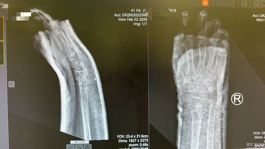 八旬老人摔倒手腕粉碎性骨折 不开刀手法复位守住腕部功能