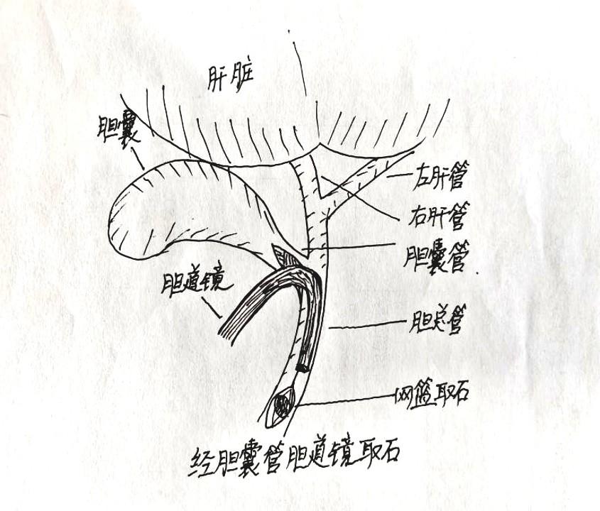 取石新突破！西北大学第一医院开展院内首例胆总管结石双镜联合经胆囊管取石术