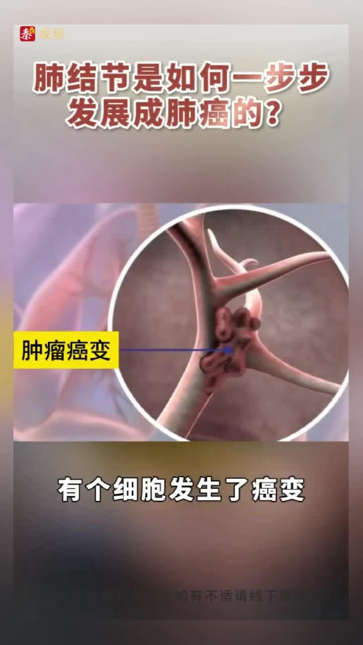 肺结节是如何一步步发展成肺癌的?
