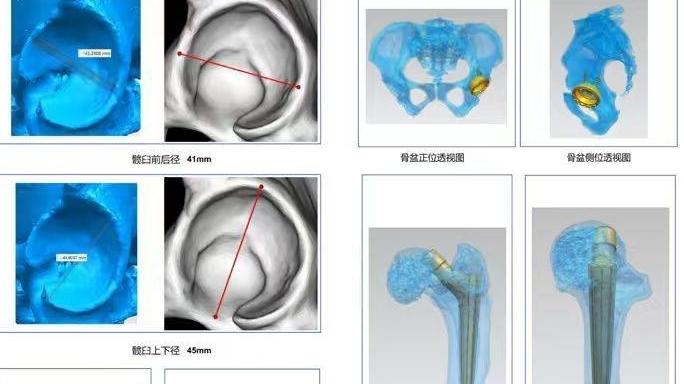 西安交大二附院完成一例数字化精准助力高难度髋关节置换手术